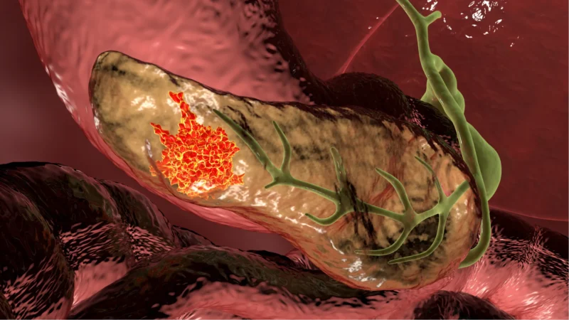 AI breakthrough from Mayo Clinic could detect pancreatic cancer up to three years early