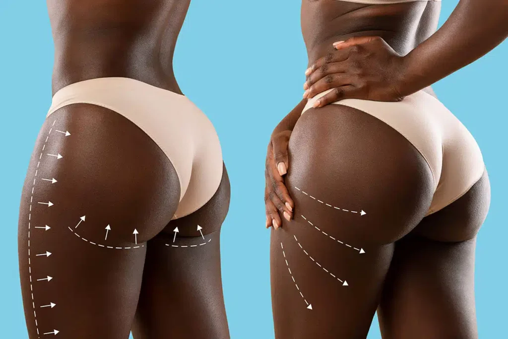 UK bans Brazilian butt lift ads over safety concerns