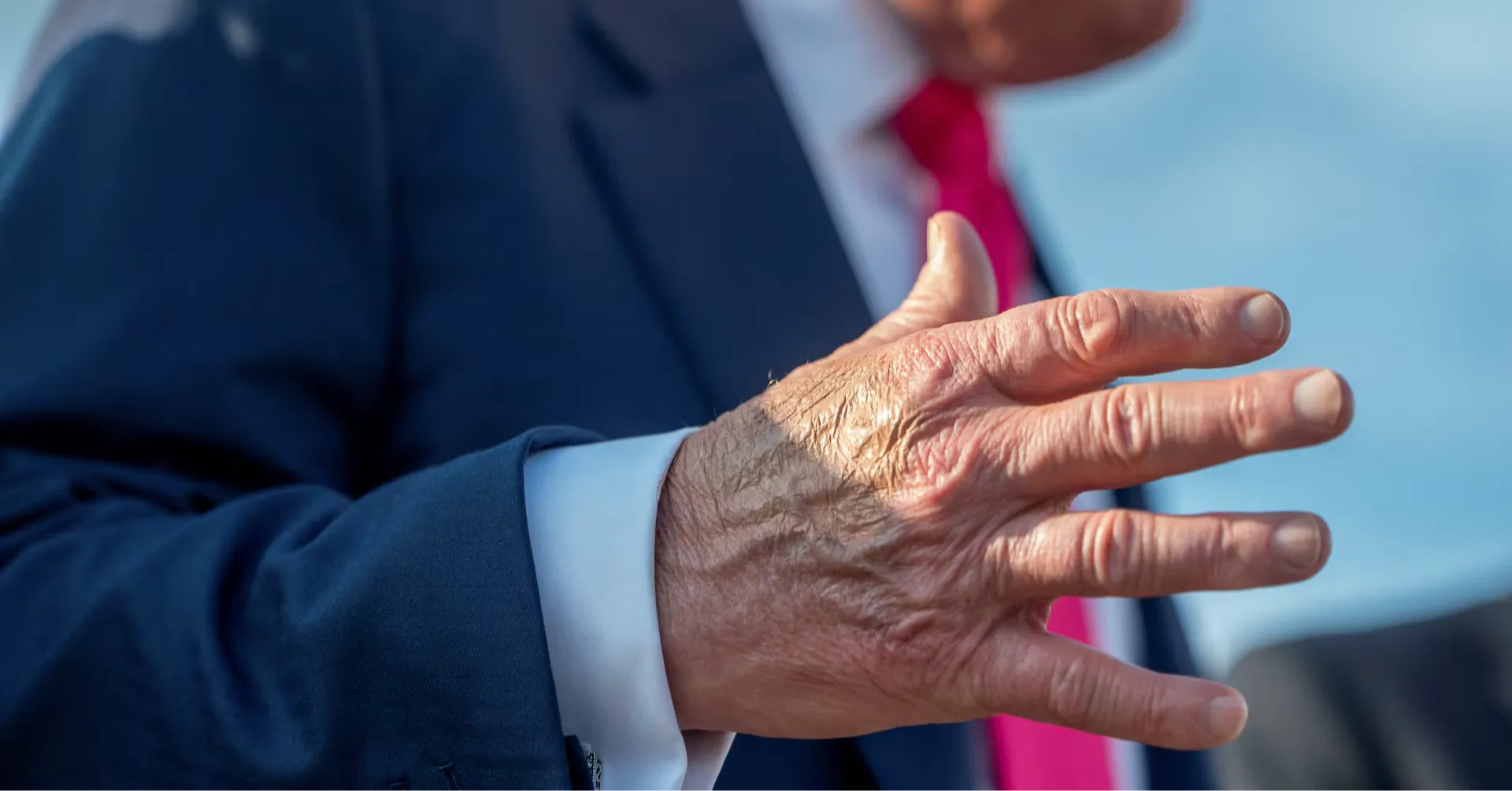 Trump diagnosed with vein condition