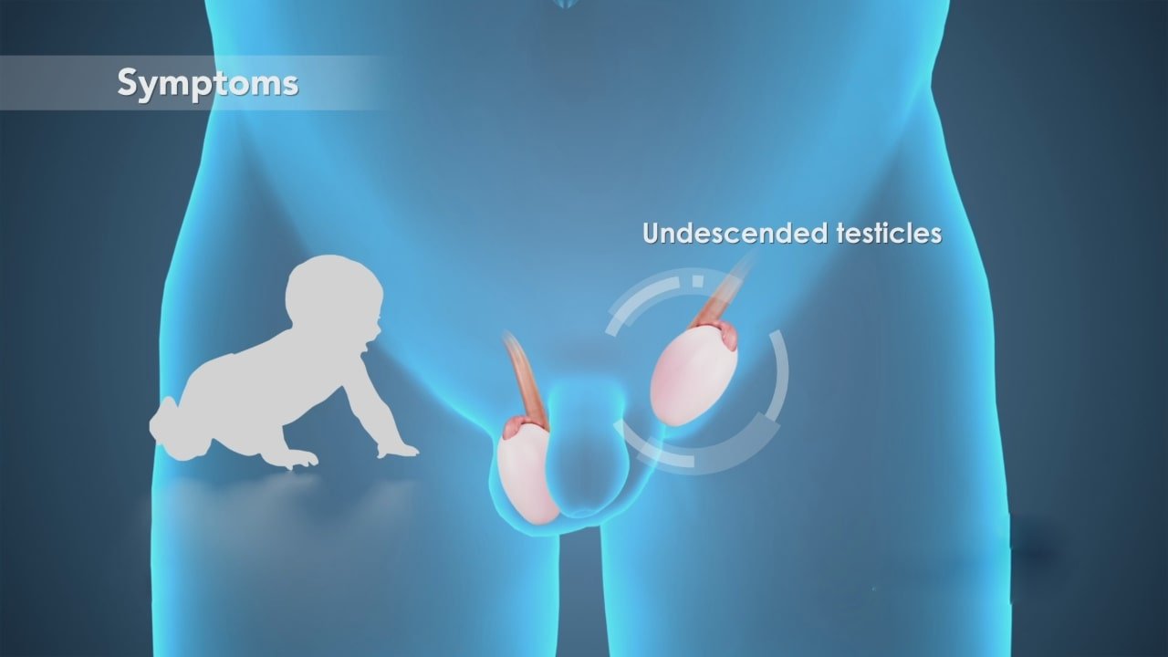 pediatric-undescended-testis-in-kenya