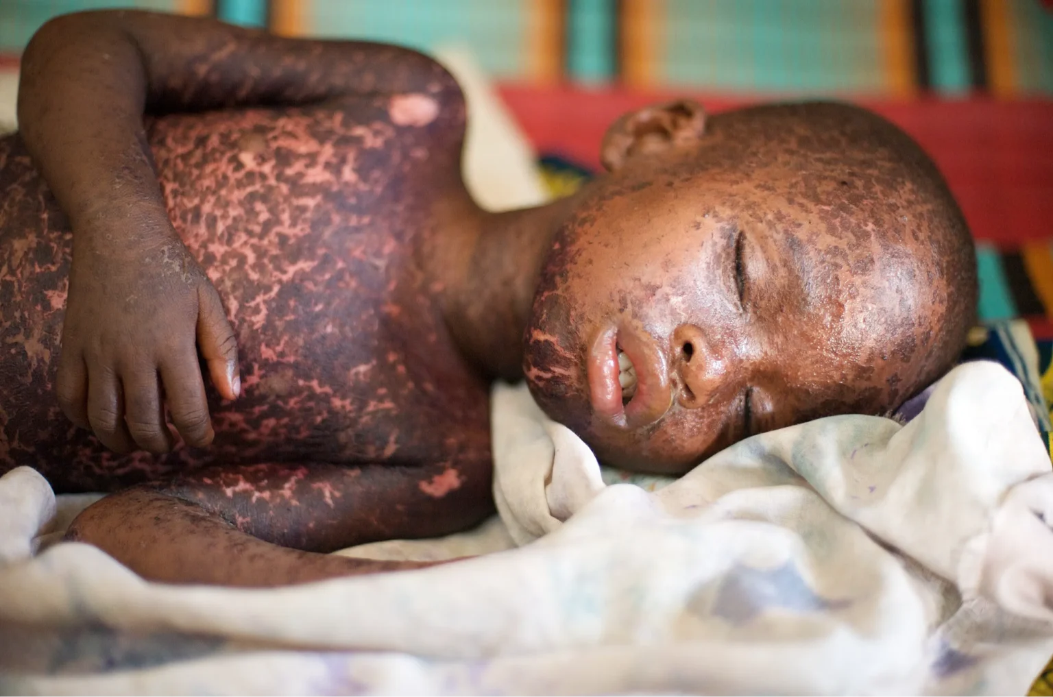 Uganda measles outbreak death toll rises to 32