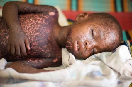 Uganda measles outbreak death toll rises to 32