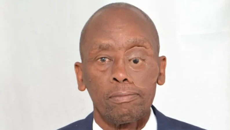 KNH performs first orbital-facial prosthesis surgery, restoring cancer survivor’s dignity